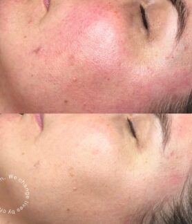 Diffused redness on face.