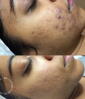 Inflammatory Acne on darker Fitzpatric skin type.
