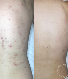 Steroid induced acne cured at Hud Skin and Body - Melbourne Skin Clinic