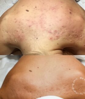 Acne scarring removal in Melbourne