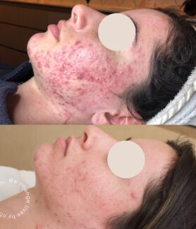 Inflamed acne journey in Melbourne