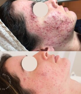 Hormonal acne journey in Melbourne