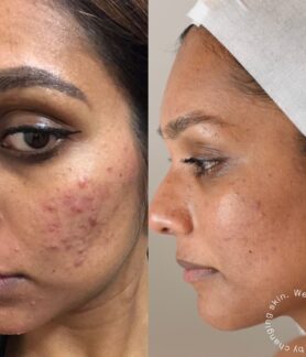 Inflammatory Acne on darker Fitzpatric skin type.