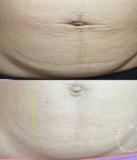 Scar reduction in Melbourne Skin Clinic