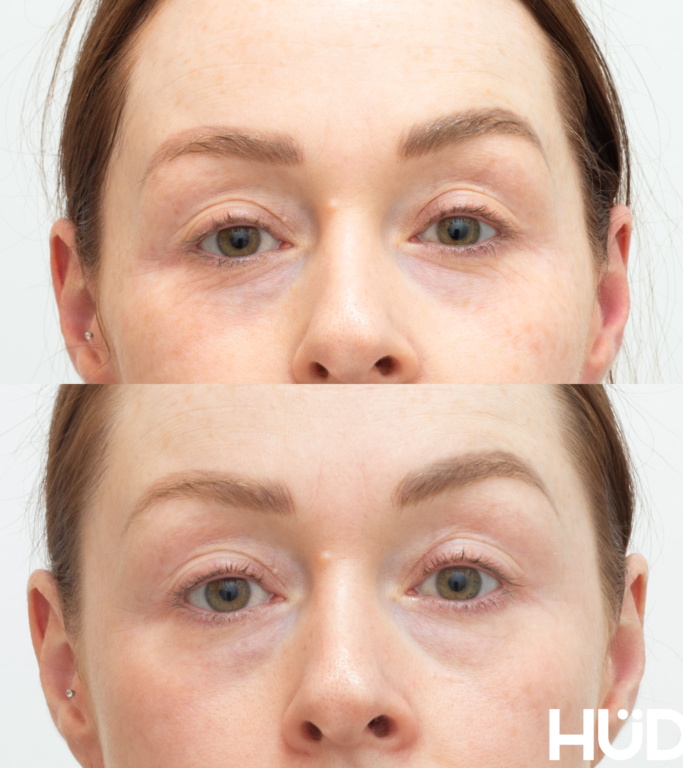 Potenza RF Needling for droopy eyes