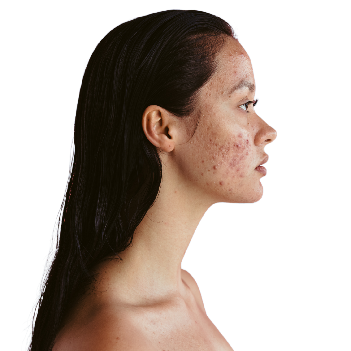 The Hidden Link Between PCOS and Acne